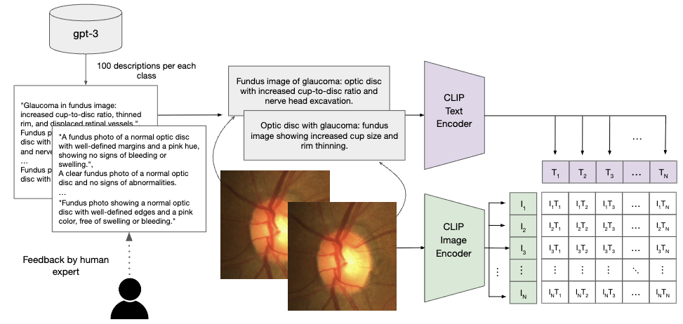 Glaucoma Diagnosis